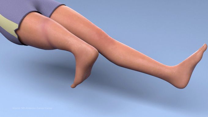 What is a rotationplasty?