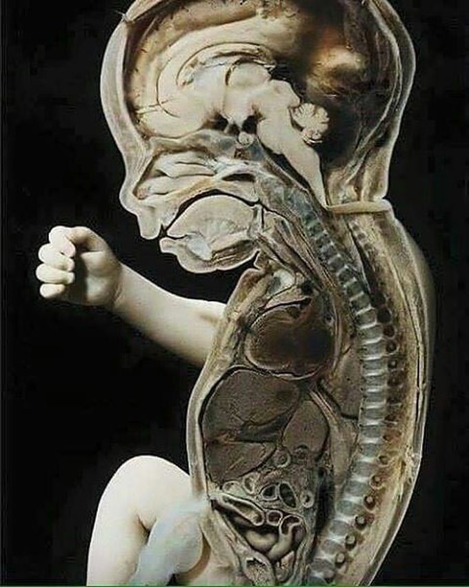 from @medicineandcoffee Anatomical section of a fetus - MEDizzy
