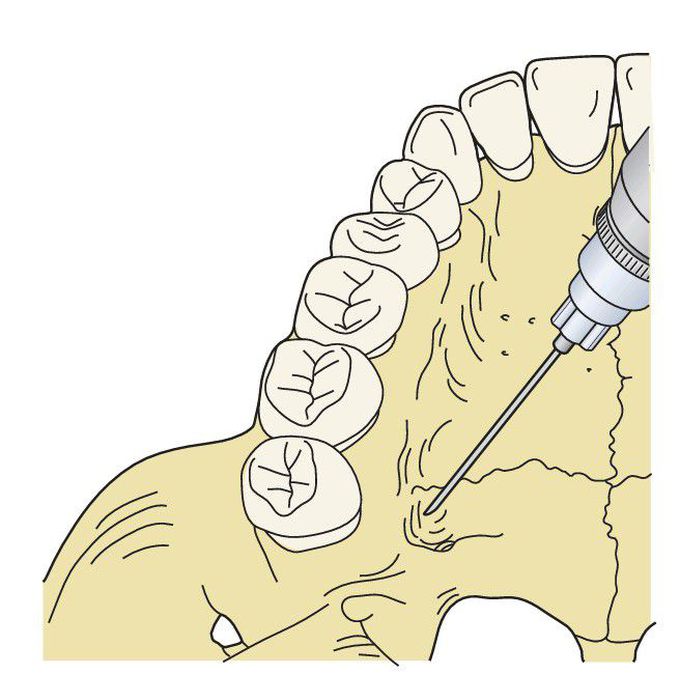 Greater palatine nerve