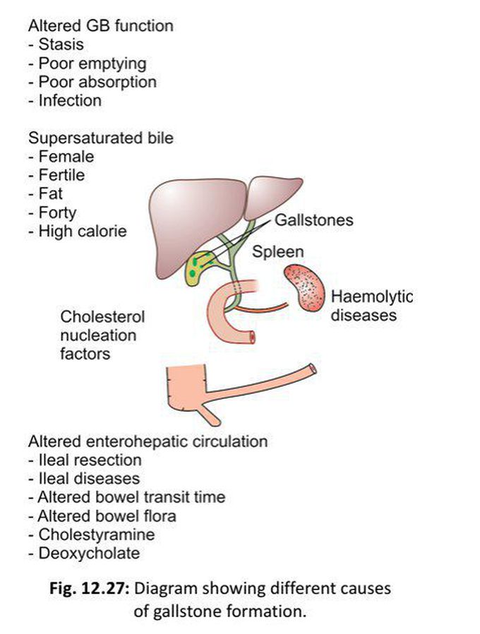 Gallstones