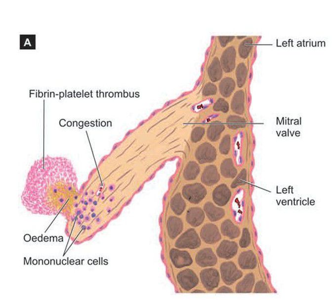 Rheumatic heart disease