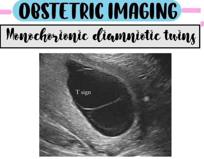 Monochorionic Diamniotic Twins