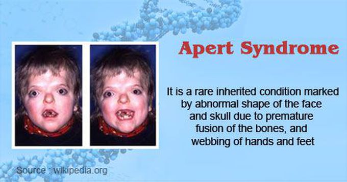 Apert syndrome