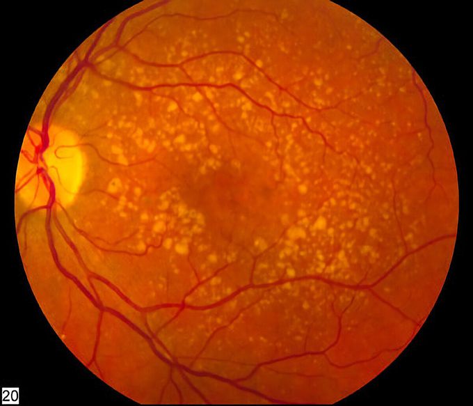 What causes macular degeneration?