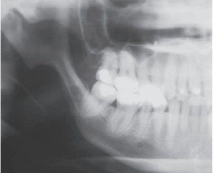 Scleroderma XRAY