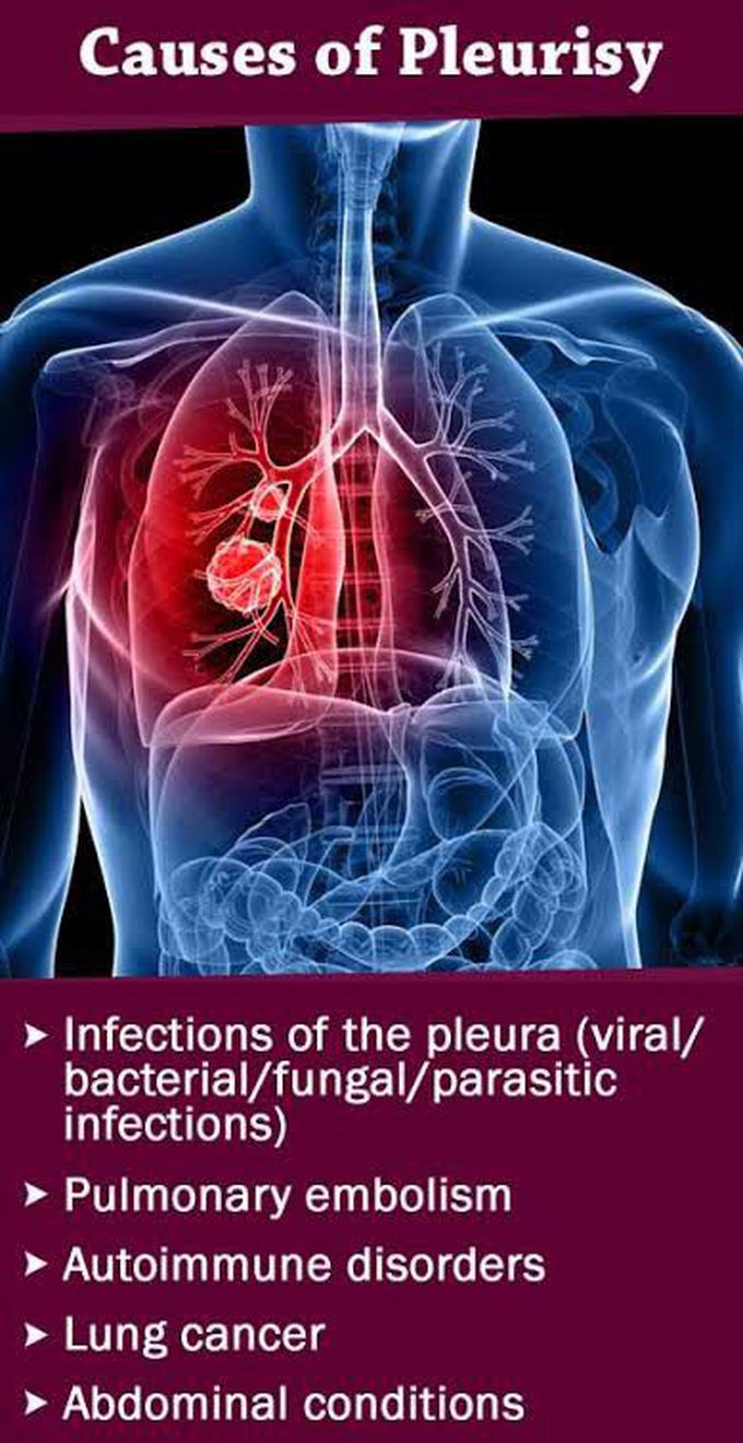 Causes of pleurisy