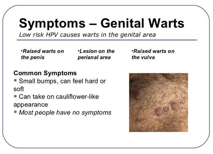 Symptoms of HPV genital warts
