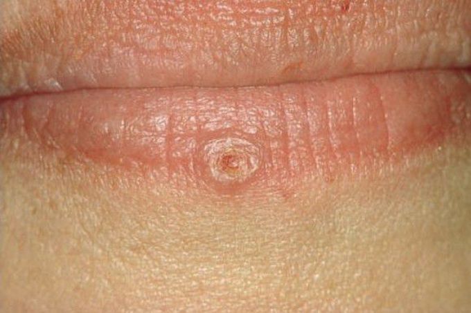 Keratocanthoma