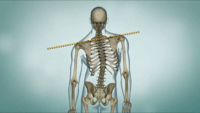 What is Scoliosis? : signs and symptoms & Treatment options