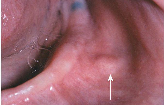 Traumatic Neuroma