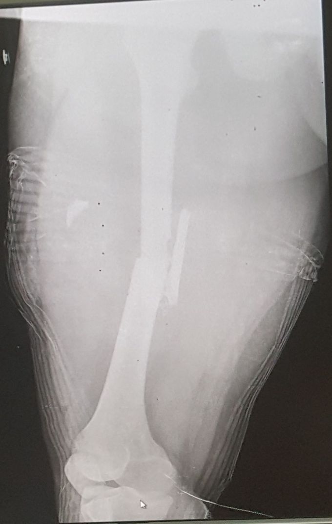 femore fracture