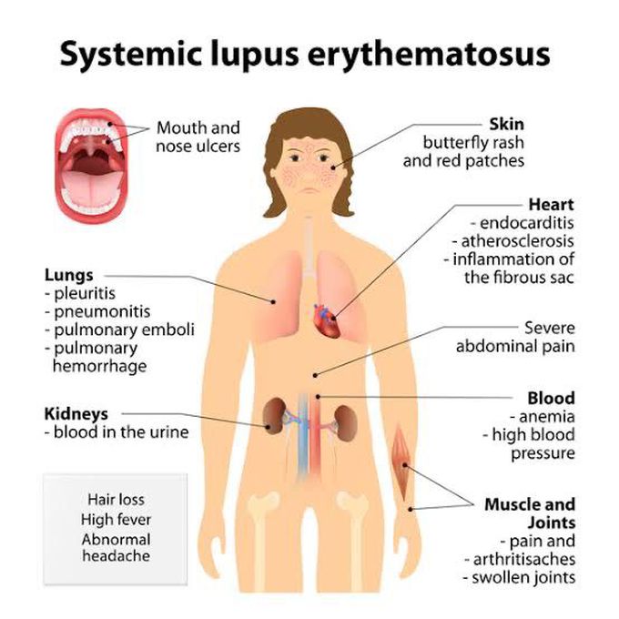 Systemic lupus erythematosus (SLE)
