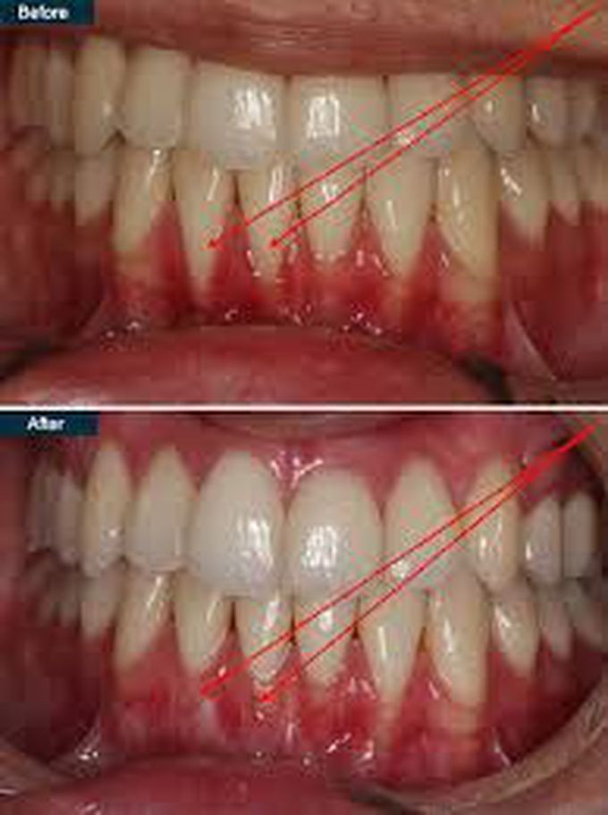 Causea of periodontal disease