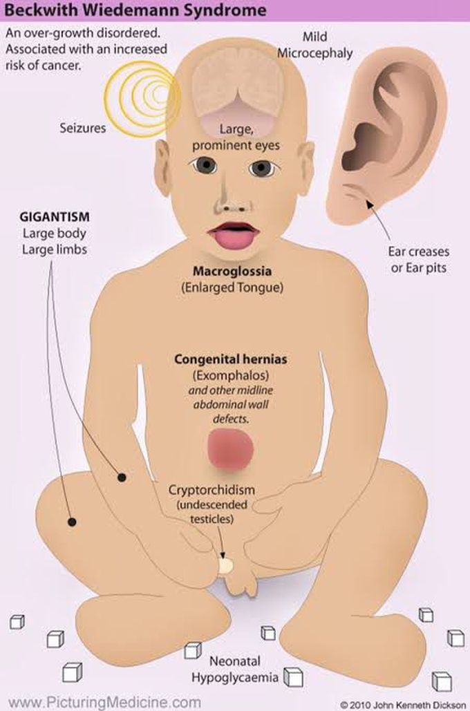 Beckwith Wiedeman Syndrome