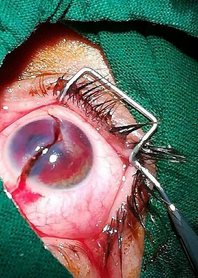 A 30-year-old man is hospitalized with a complaint of eye damage as a result of a foreign object being thrown into his eye. Within four hours of surgery, the foreign body is removed and the suture is done delicately, but, unfortunately, the person loses his sight despite the great efforts of the medical staff.