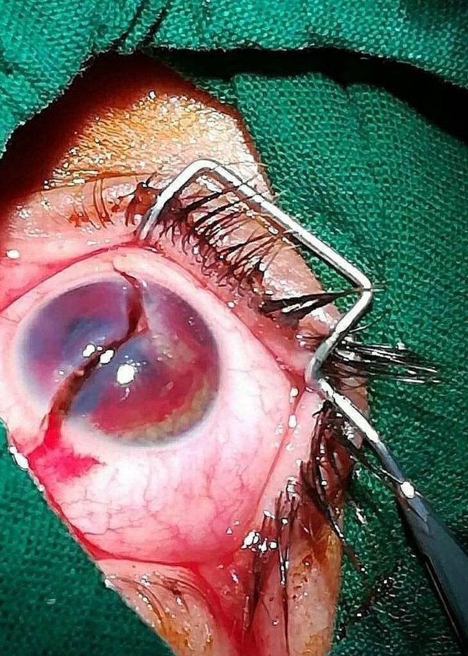 A 30-year-old man is hospitalized with a complaint of eye damage as a result of a foreign object being thrown into his eye. Within four hours of surgery, the foreign body is removed and the suture is done delicately, but, unfortunately, the person loses his sight despite the great efforts of the medical staff.