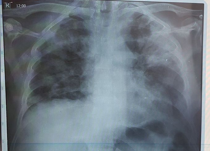COVID-19 BEFORE TREATMENT