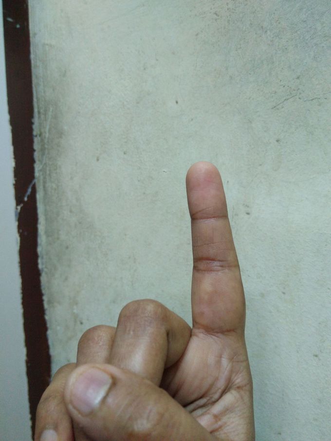 Swelled finger(point finger)
