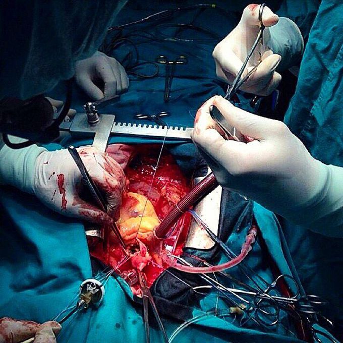 Cardiothoracic surgeons on duty! Performing heart valve replacement.