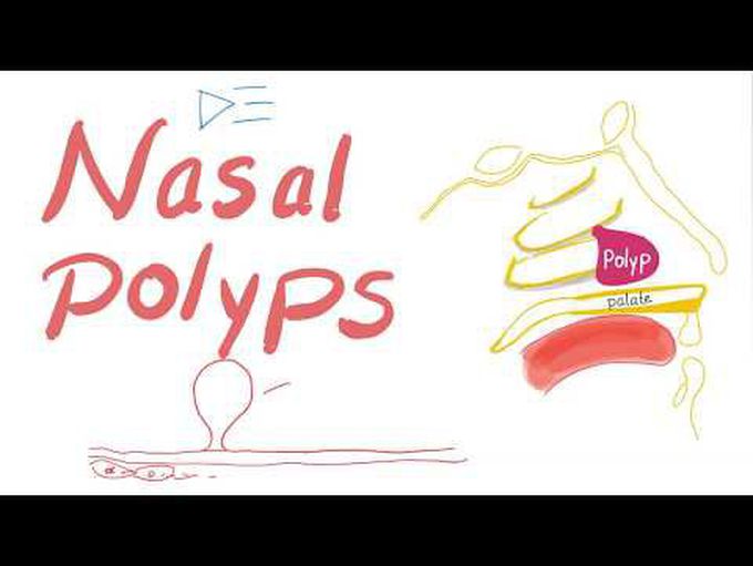 Pathology of Nasal Polyps