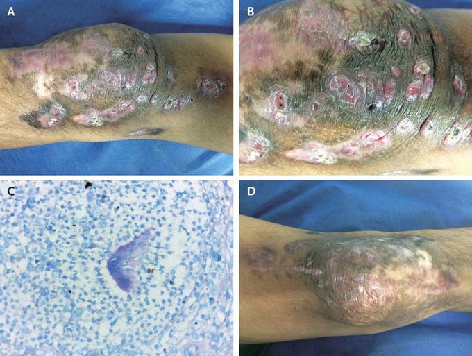 Cutaneous Actinomycosis