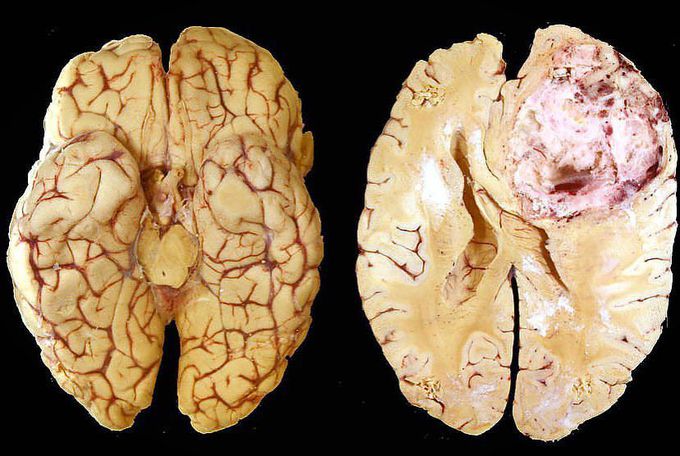 Glioblastoma Multiforme!  