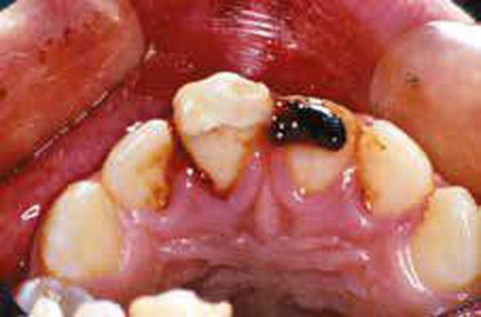 Enamel-dentine-pulp fracture