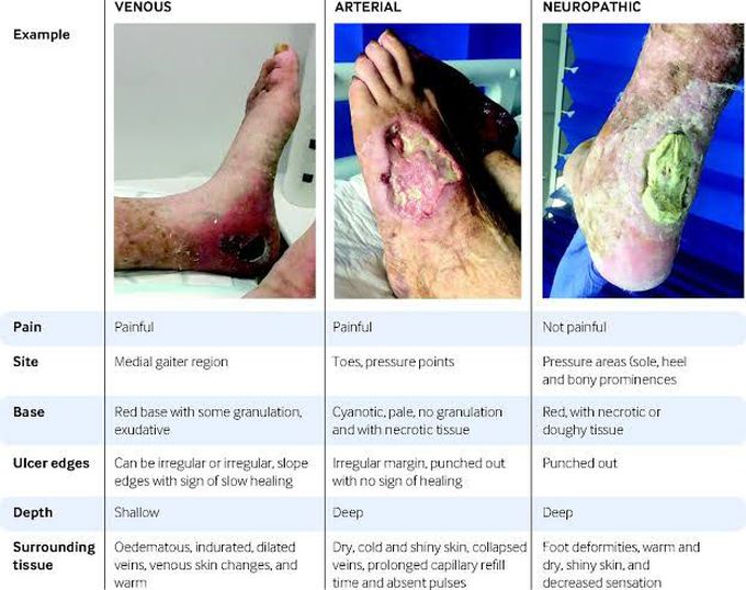 Lowe Limb Ulcers- Arterial, venous or neuropathic?