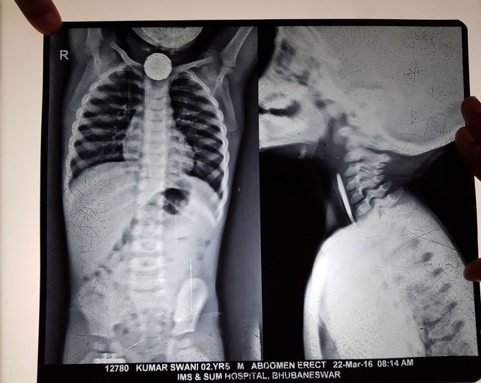 X-ray-Foreign body oesophagus