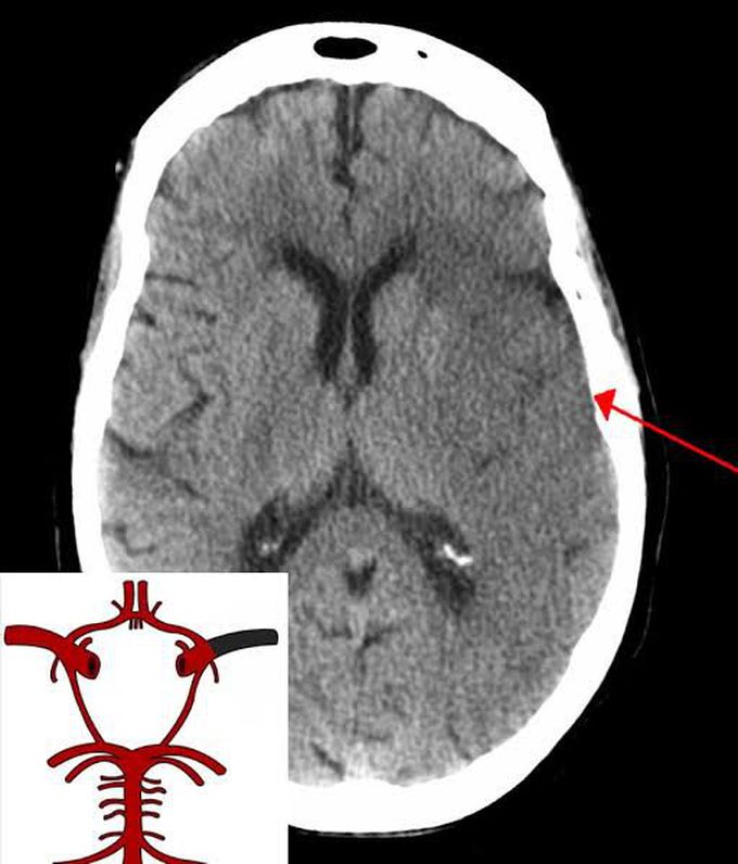 Bamford classification of stroke