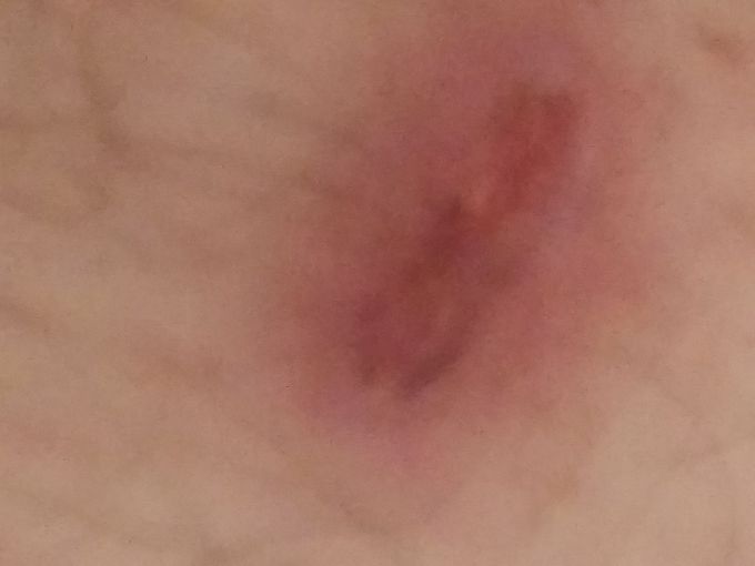 Diabetic sore