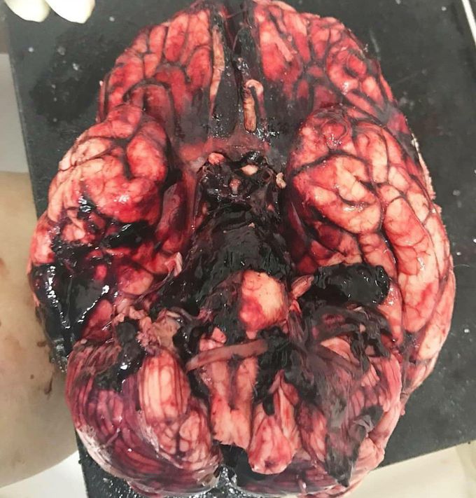 Ruptured right posterior communicating artery, most likely a berry aneurysm.