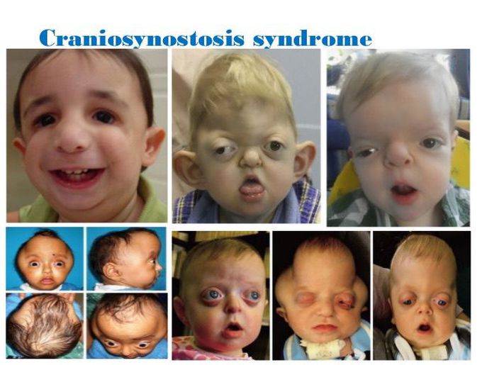 Craniosynostosis