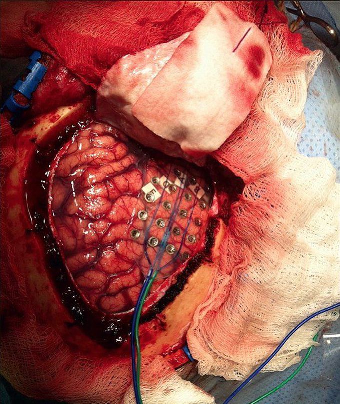 Finding an epileptogenic area!
