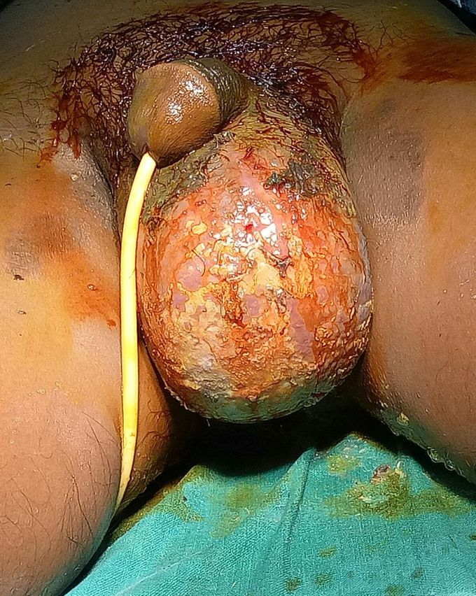 Testitis