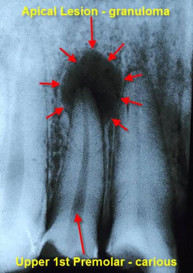 Symptoms of periapical granuloma