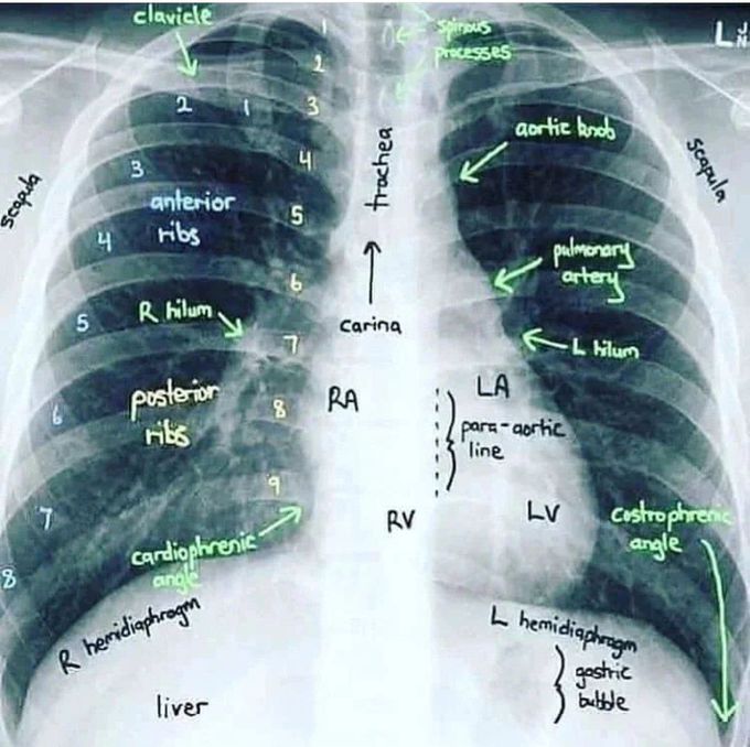 Normal Chest X-ray