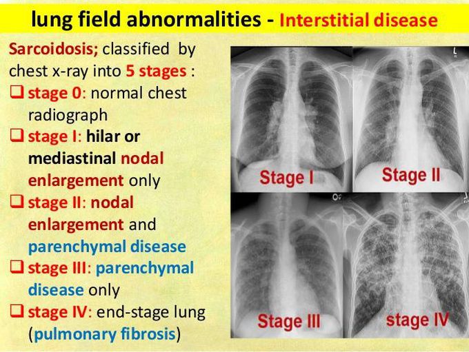 Chest X-ray changes in sarcoidosis - MEDizzy