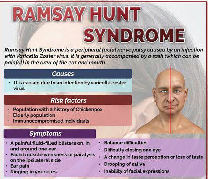 These are the causes,risk factors and symptoms of Ramsay Hunt syndrome