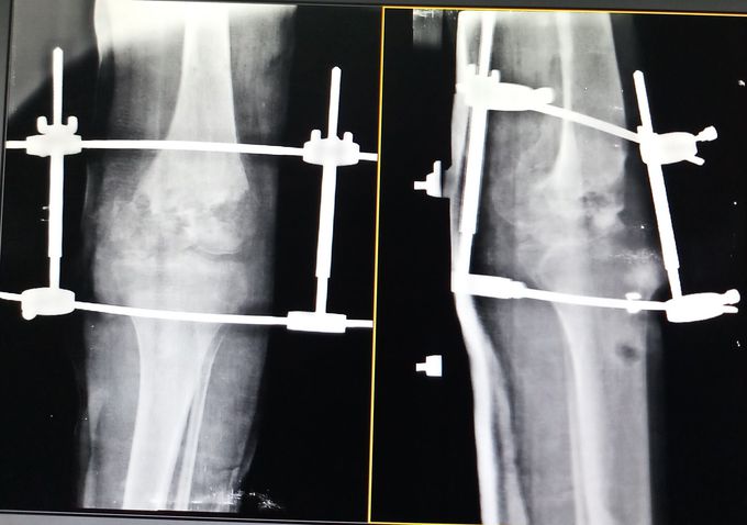 Right knee
