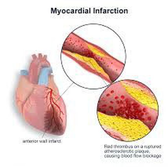 What is myocardial infarction