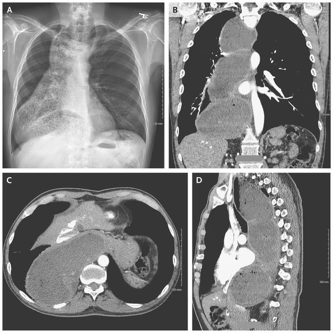 Achalasia with Megaesophagus