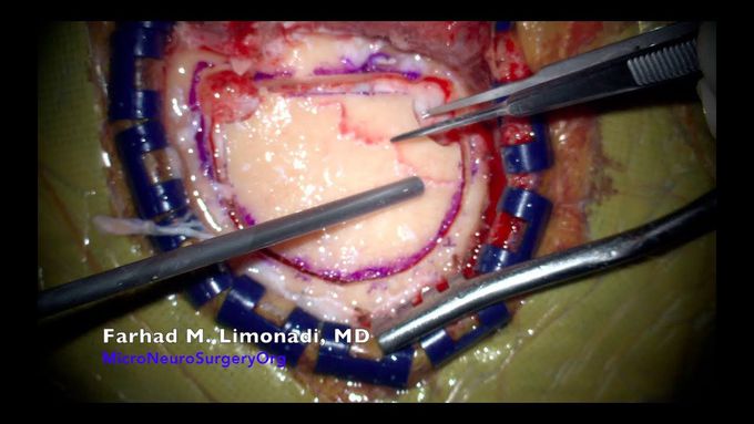 Glioblastoma Multiforme (GBM): Actual video of brain surgery and resection of GBM