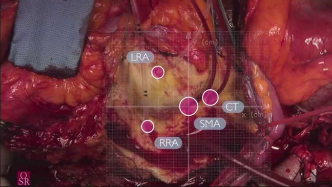 Video-atlas of open thoracoabdominal aortic aneurysm repair