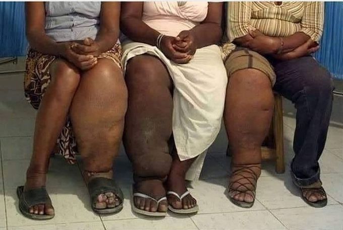These people are suffering from??