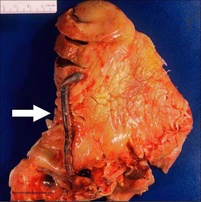 Coronary bypass!!