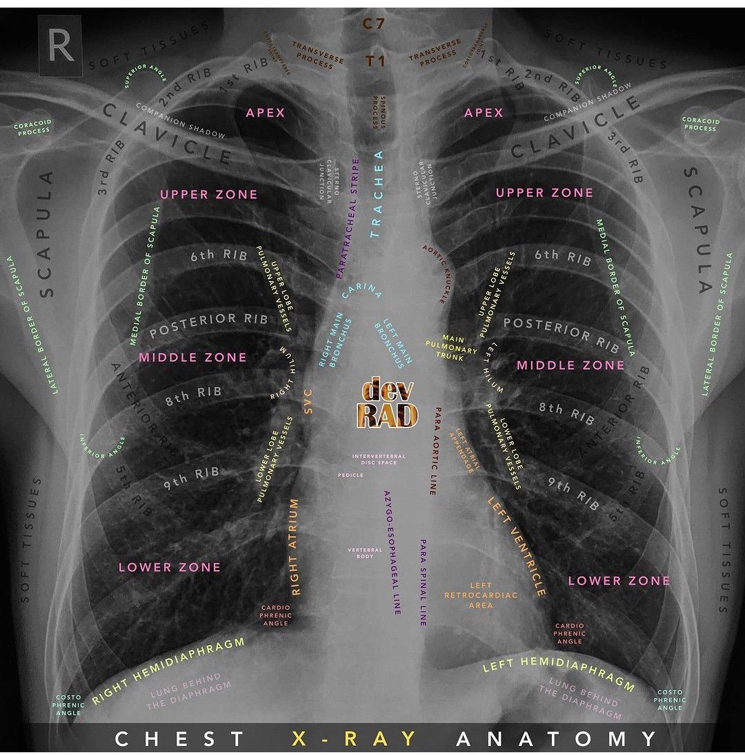 Amazing shot of the chest anatomy labeled on X-Ray - MEDizzy