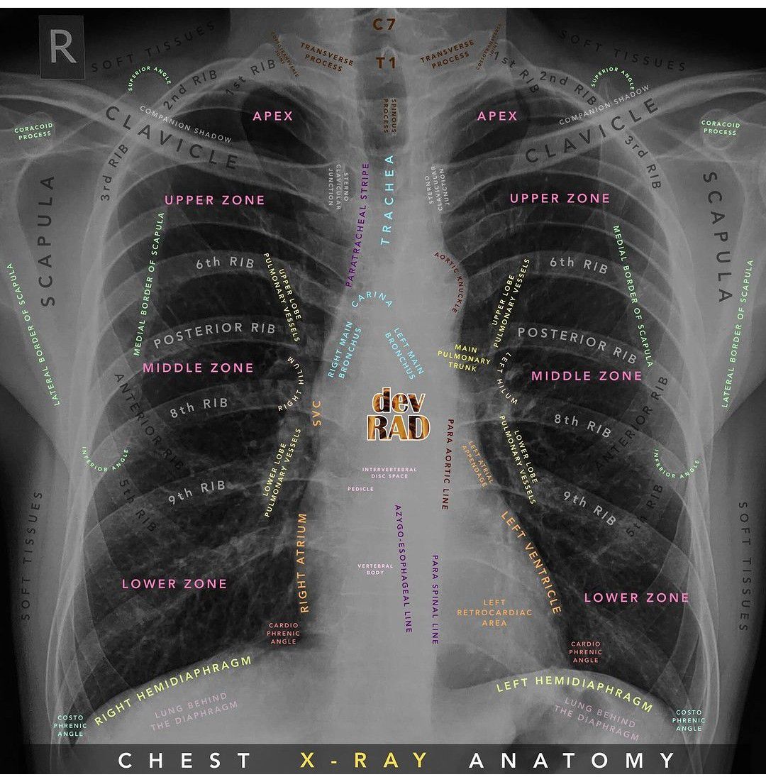 Chest X-ray Anatomy - MEDizzy