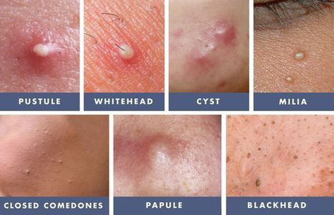Injctions of skin