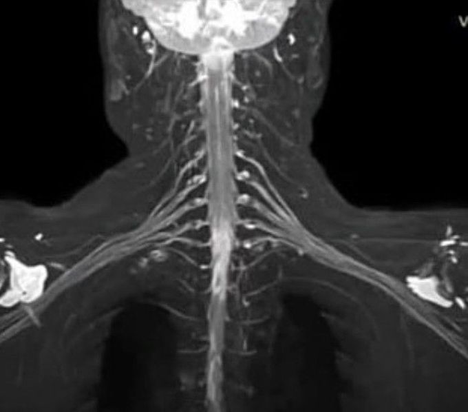 High resolution MRI of Brachial plexus